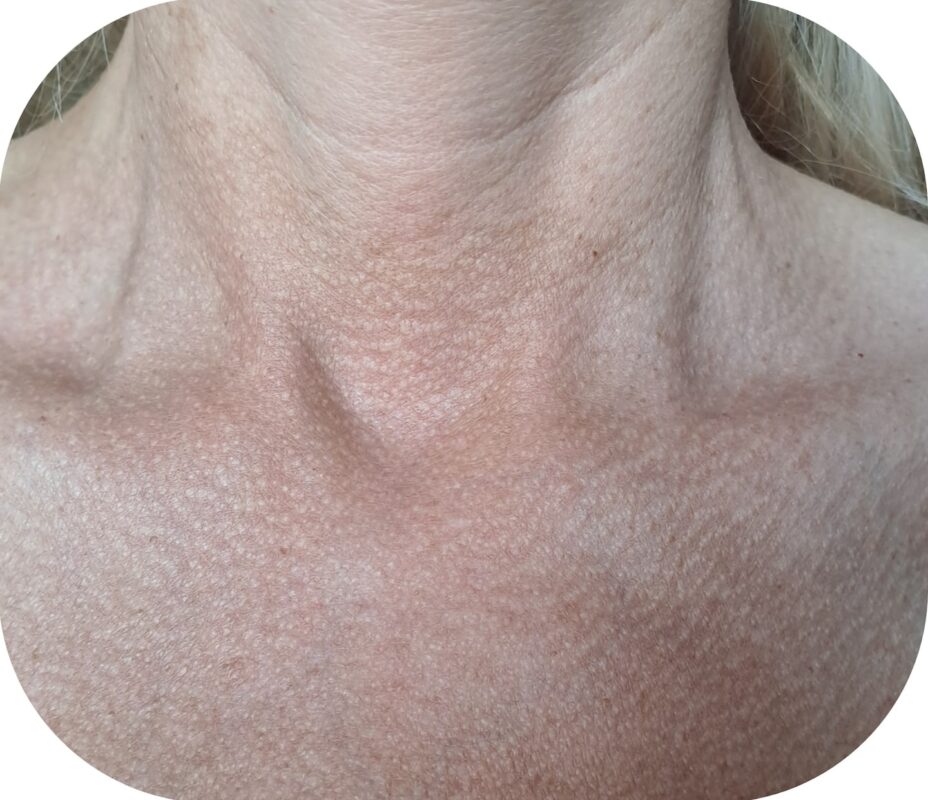 pigmentinės dėmės ant kaklo